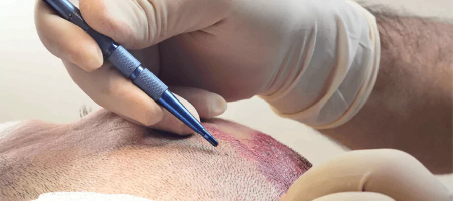 saphir-fue-haartransplantation