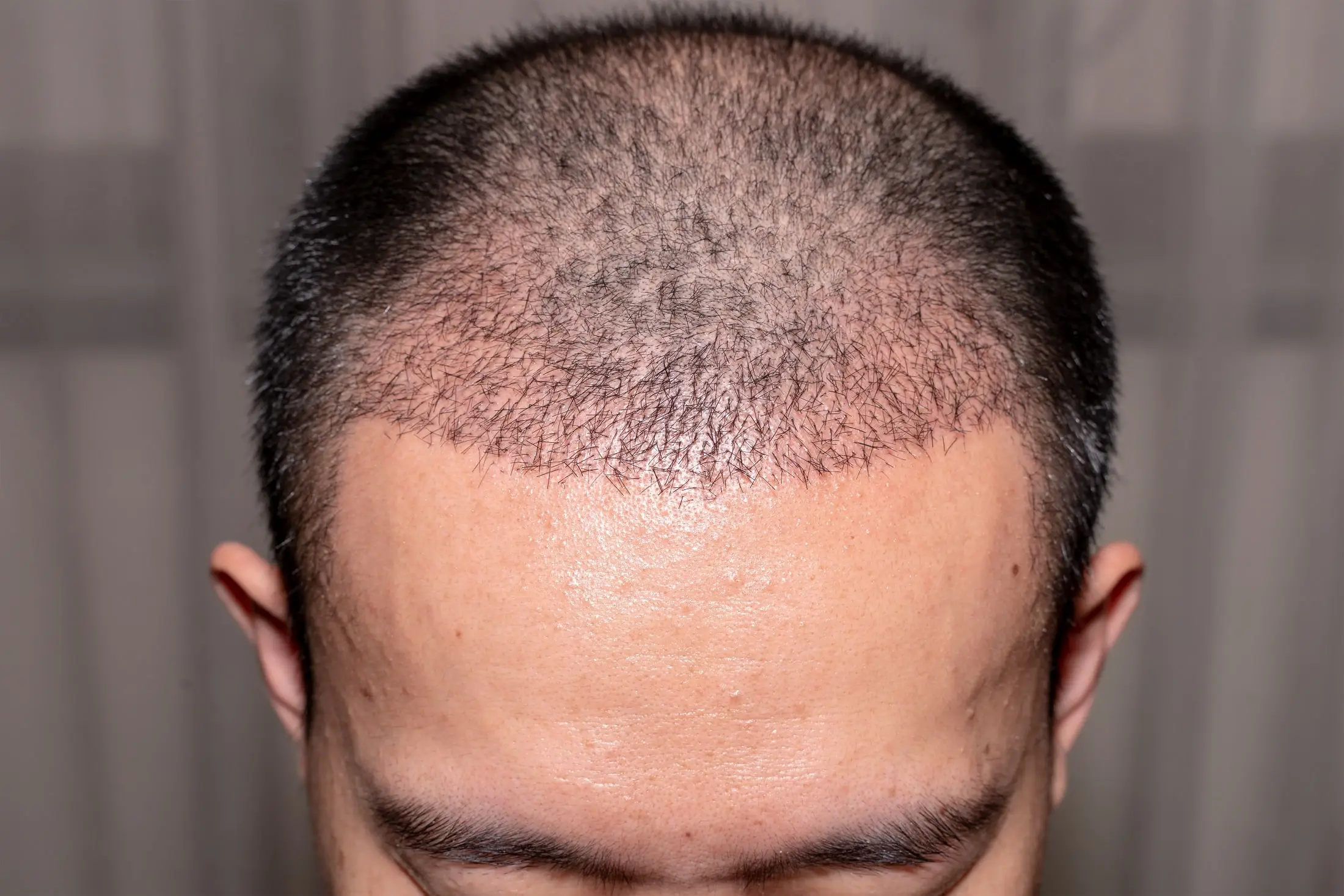 Ist eine Haartransplantation dauerhaft?