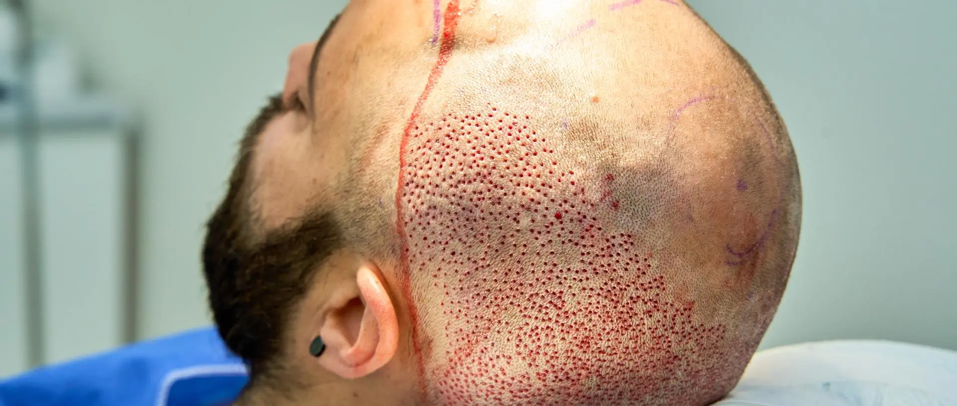 Haartransplantation 3