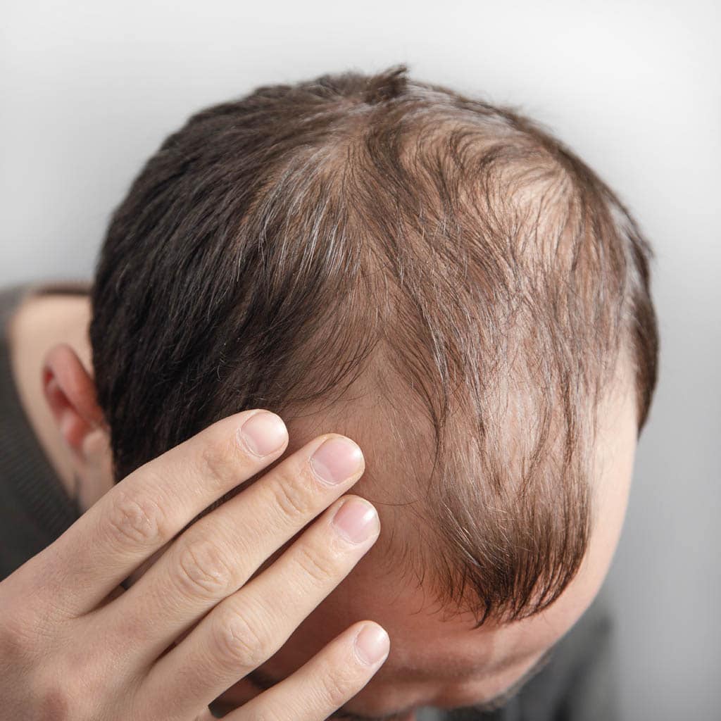 Haartransplantation 52