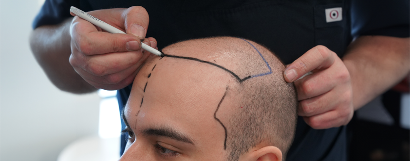 Haartransplantation 4