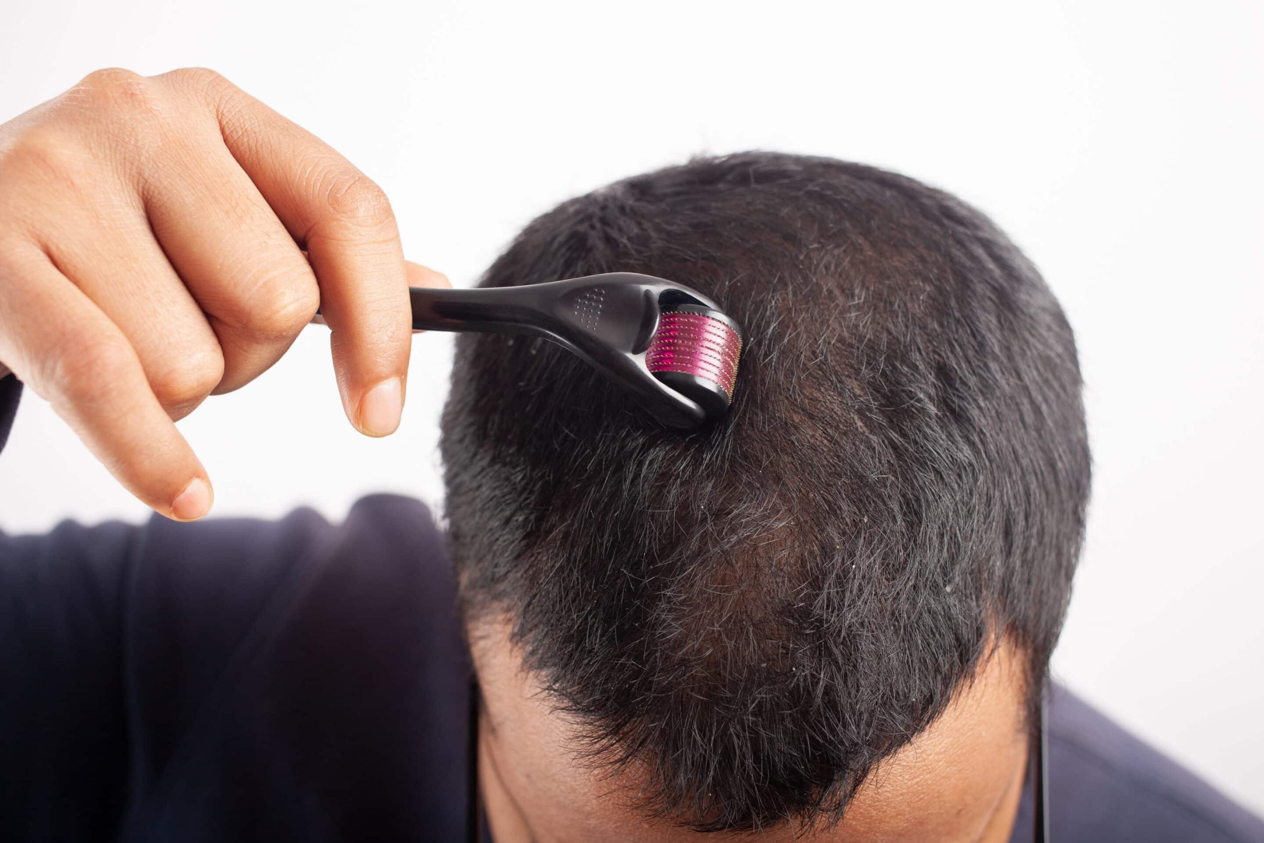 Dermaroller bei Haarausfall