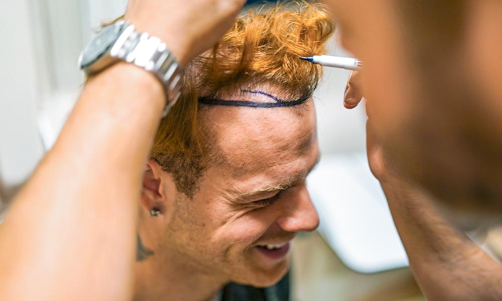 Haartransplantation mannheim