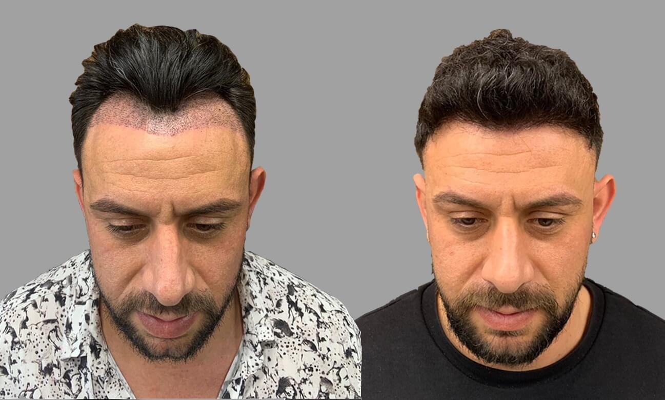 haartransplantation (1)
