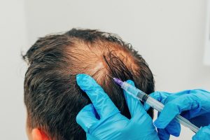 Haarausfallbehandlung