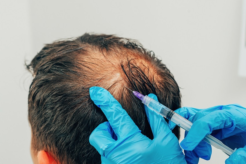 Mesotherapy of hair and head. Injections in the head. Fighting h
