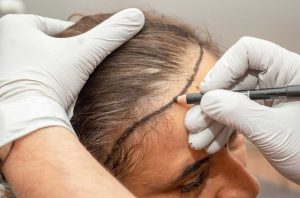 Haartransplantation