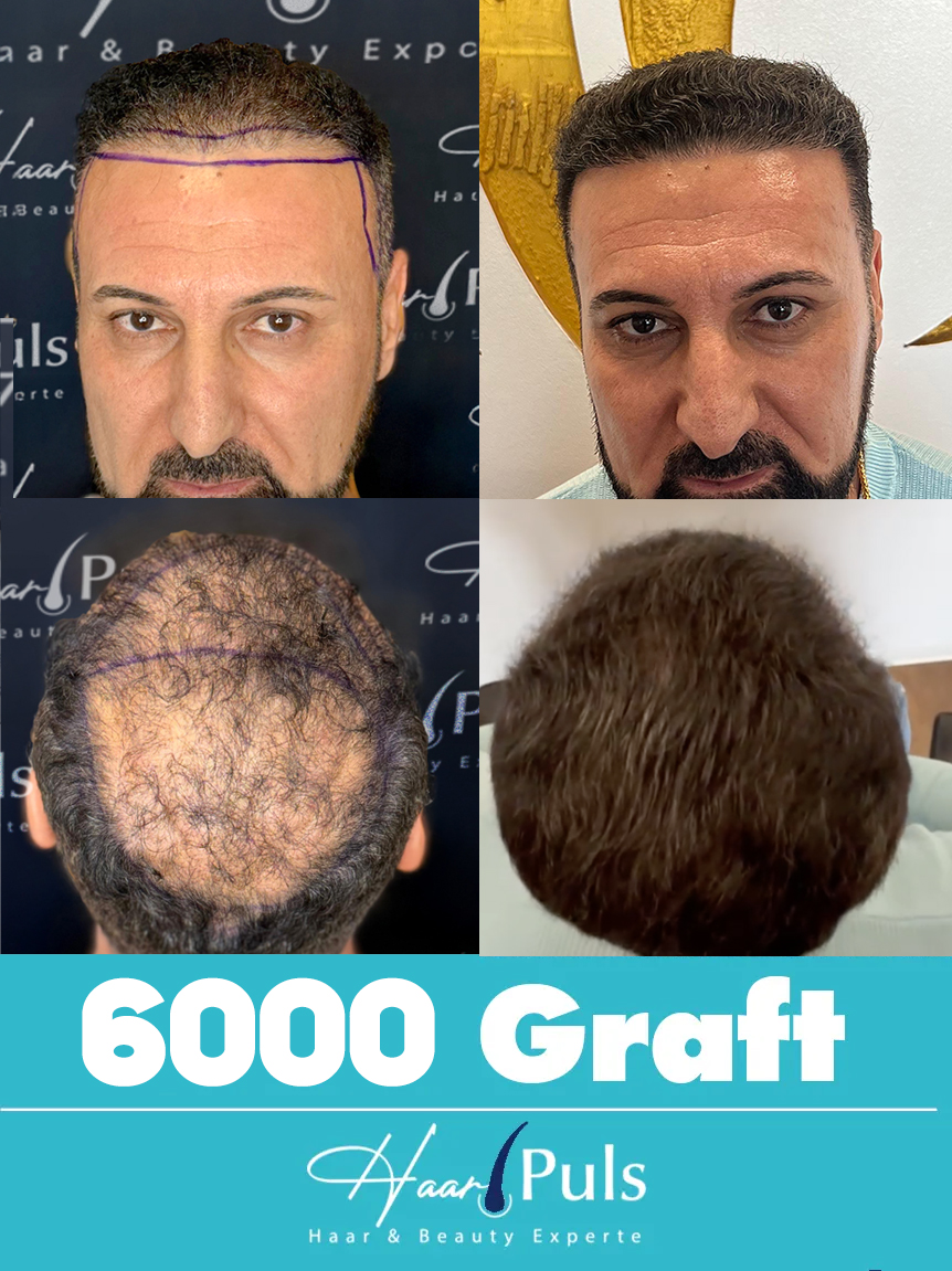 Haartransplantation Deutschland Kosten 2026.webp