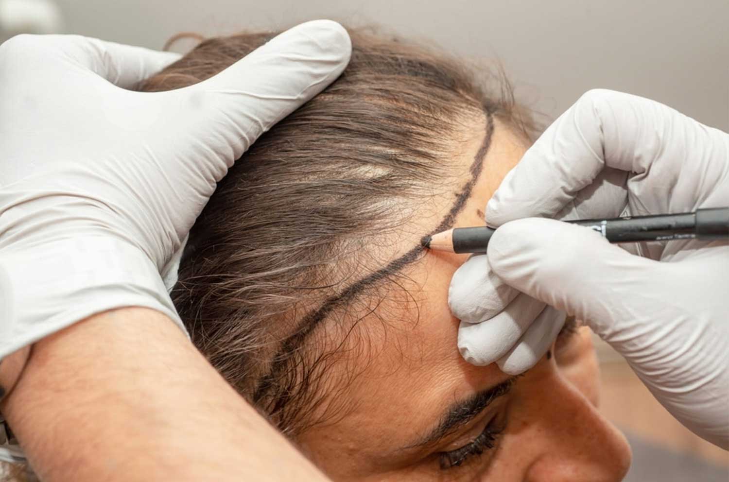 Haartransplantation