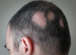 alopezie