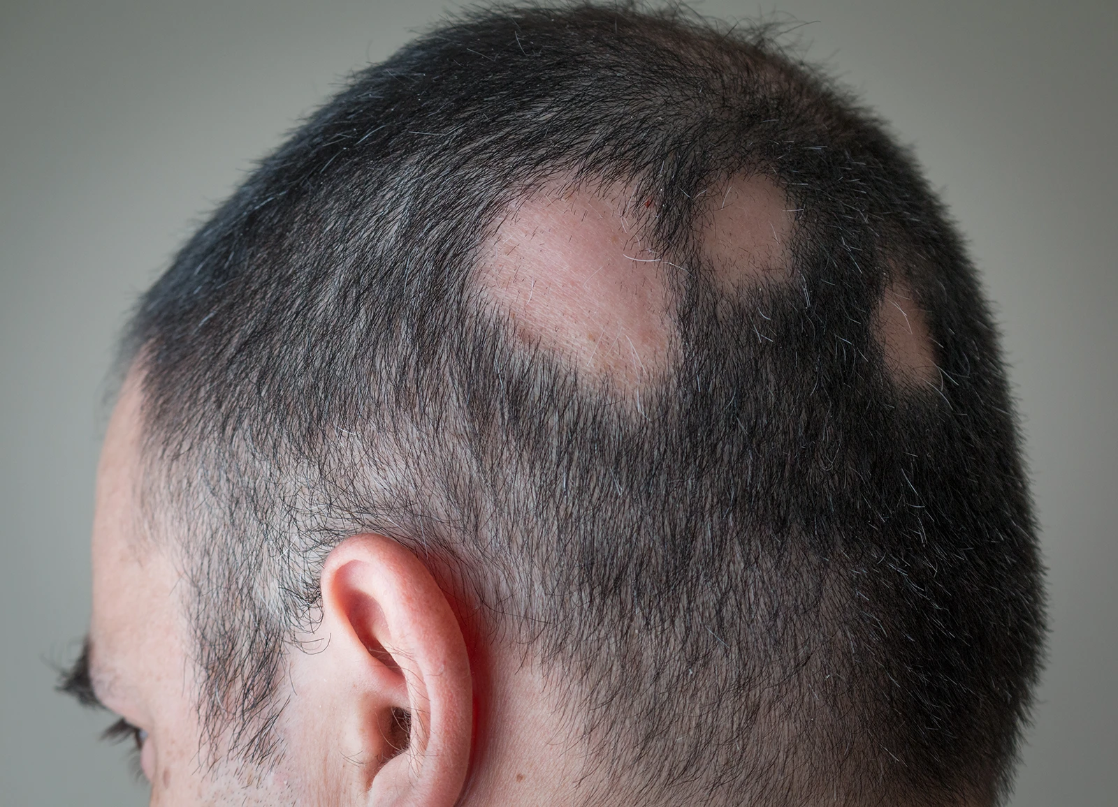 alopezie